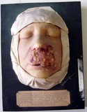Syphilomatose ulcérante de la face, aiguë, lupoïde ou tuber-culoïde